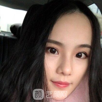 重慶聯(lián)合麗格王巖玻尿酸隆鼻三個月了，分享果照片~